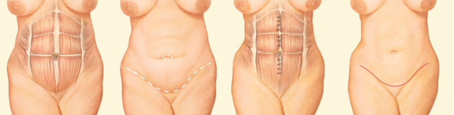 Tummy Tuck Binder (Abdominoplasty)